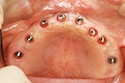 implant3