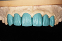 fullzirconia1