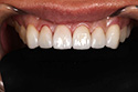 fullzirconia6