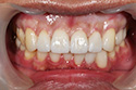 fullzirconia3